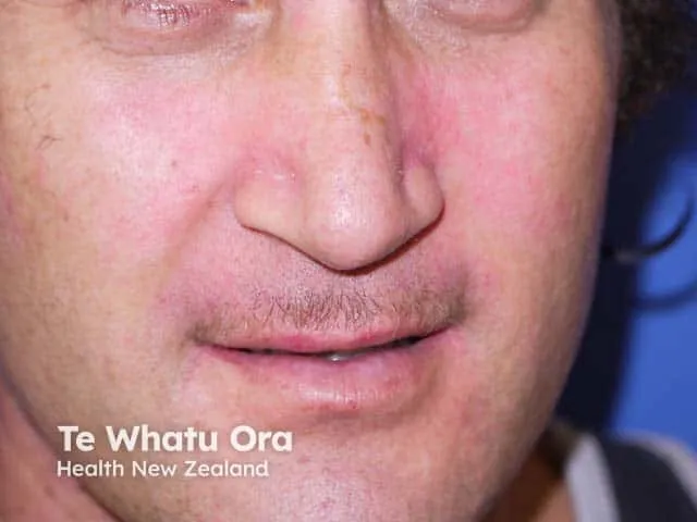 Seborrhoeic dermatitis affecting the cheek and nasolabial fold