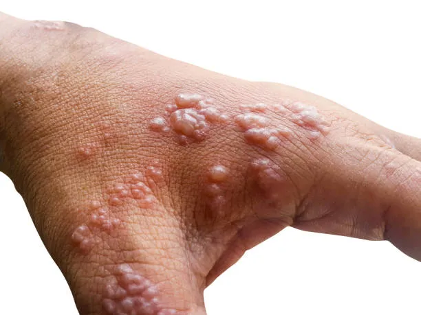 Allergic contact dermatitis with blistering on the hand