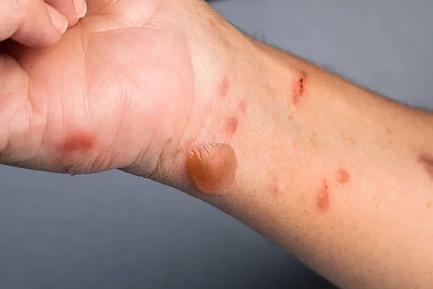 Blisters on the hands and forearms