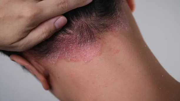Scalp psoriasis with thick scale extending beyond the hairline