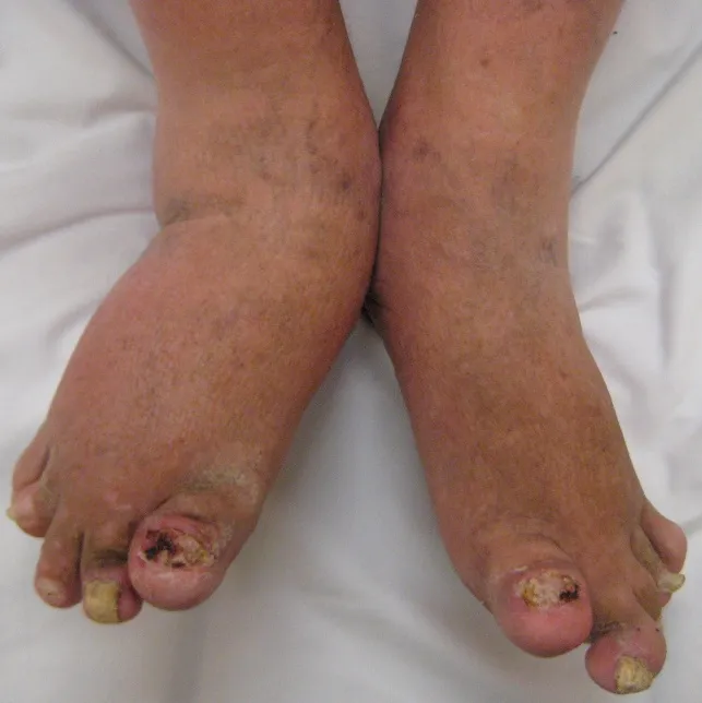 Psoriatic arthritis