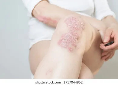 Chronic plaque psoriasis on the knee