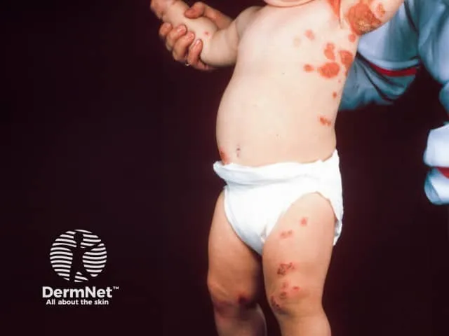 Impetigo with "kissing lesions" in the axilla of an infant