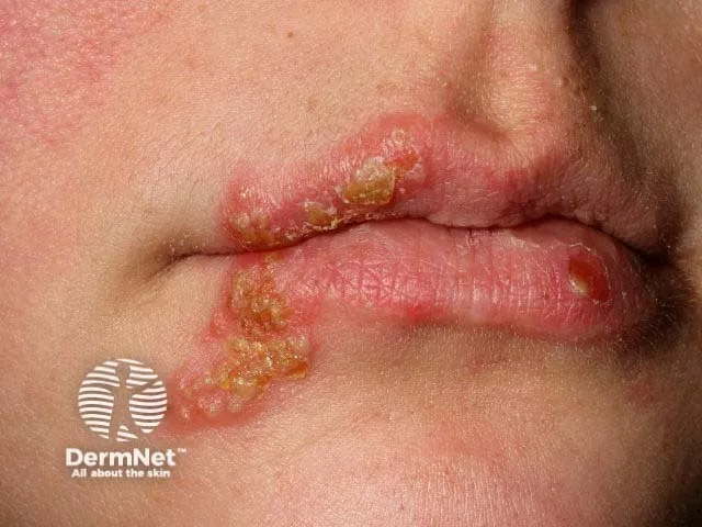 Herpes simplex vesicles on the skin