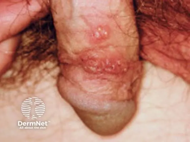 Herpes labialis on the lip