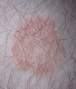 Tinea (ringworm) on the leg