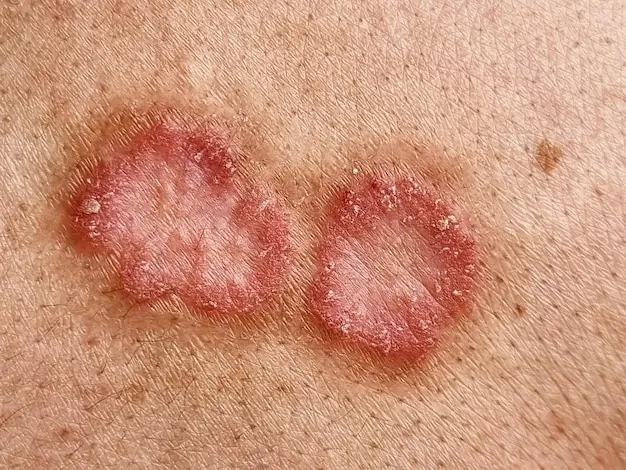 Tinea corporis on the back