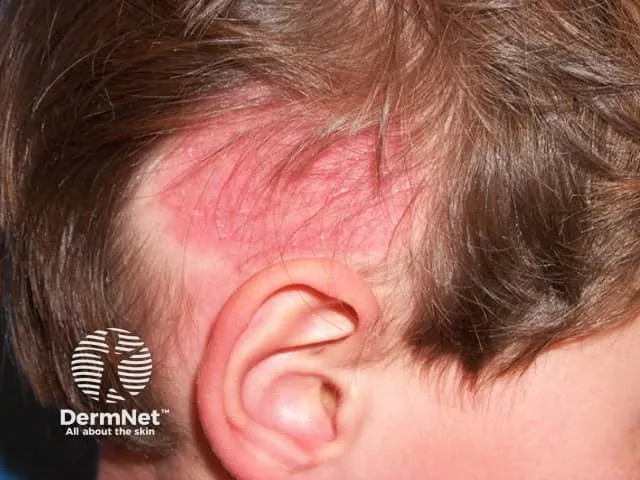 Tinea capitis on the scalp