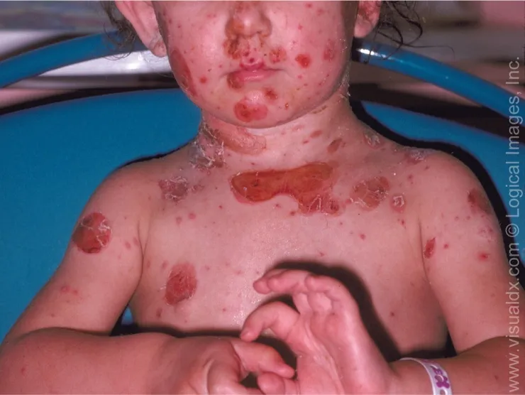 Crusted impetigo lesions around the mouth and nose