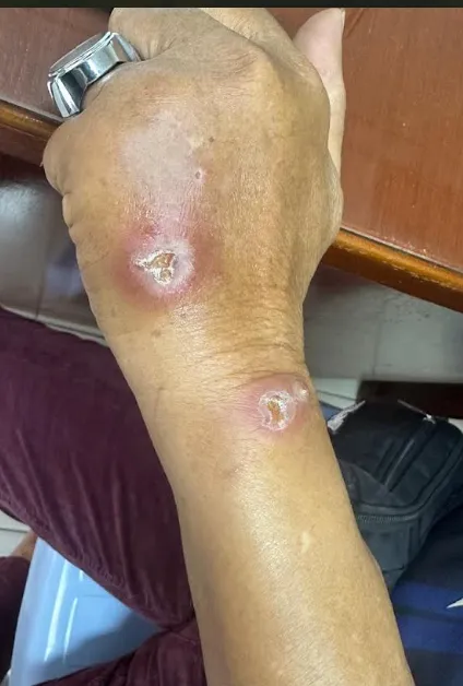 Nodular ulcerating lesions and blistering on the hand and forearm in sporotrichosis