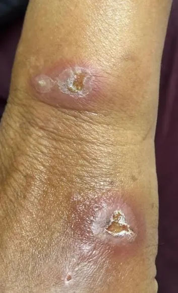 Close-up of blistering and nodular lesions on the hand in sporotrichosis