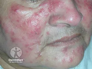 Rosacea with centrofacial erythema, papules, and pustules