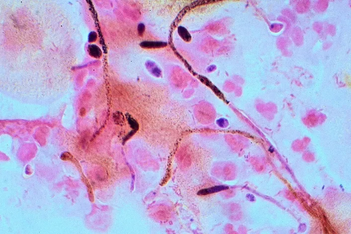 Vulvovaginal candidiasis with erythema and white curd-like discharge
