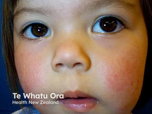 Bilateral cheek eczema — atopic eczema on the face