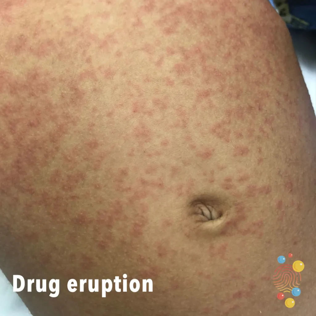 Widespread maculopapular drug eruption on the trunk