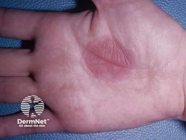 Oval erythematous fixed drug eruption on the palm with post-inflammatory hyperpigmentation