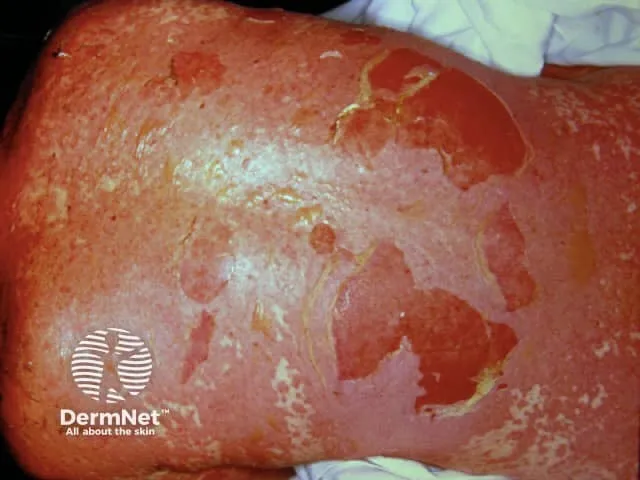 Targetoid lesions and mucosal erosions in Stevens-Johnson Syndrome / Toxic Epidermal Necrolysis