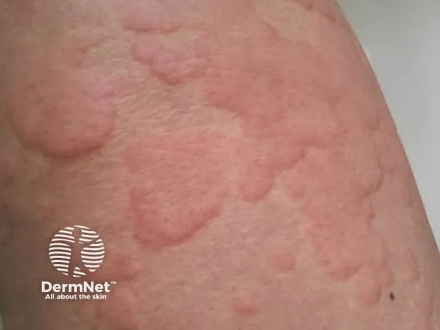 Urticaria — raised, erythematous wheals on the skin