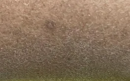 Xerosis with scaling on lower leg