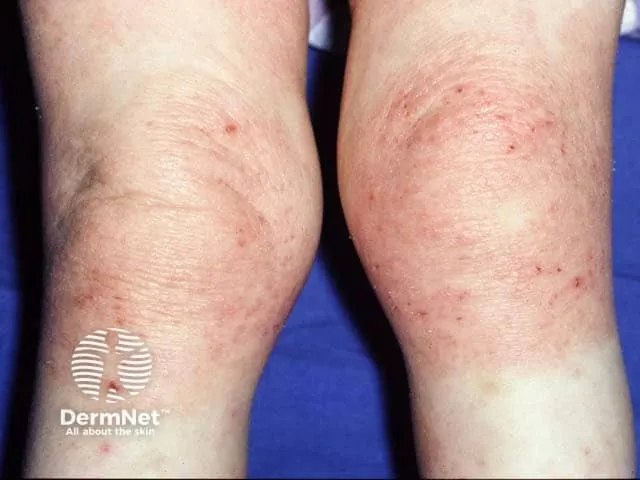Lichenified atopic eczema on the knees (reverse pattern eczema)