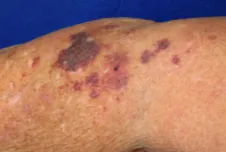 Senile purpura on the dorsum of the hand