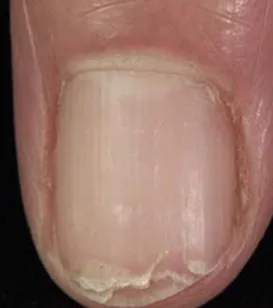 Brittle nails and onychomycosis in an elderly patient