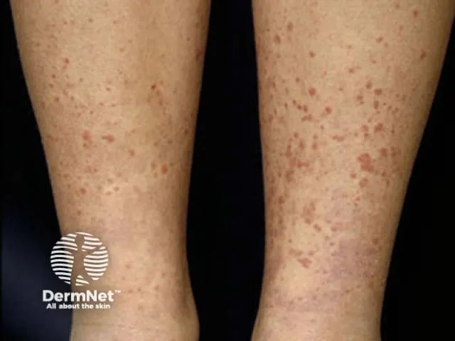 Henoch-Schönlein purpura — palpable purpura on the legs