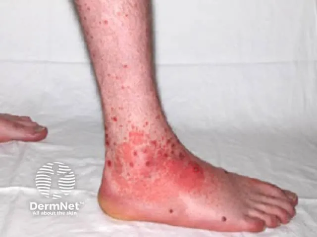 Classical purpura on lower limbs in HSP