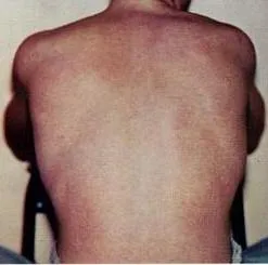 Characteristic maculopapular rash of dengue fever on the back