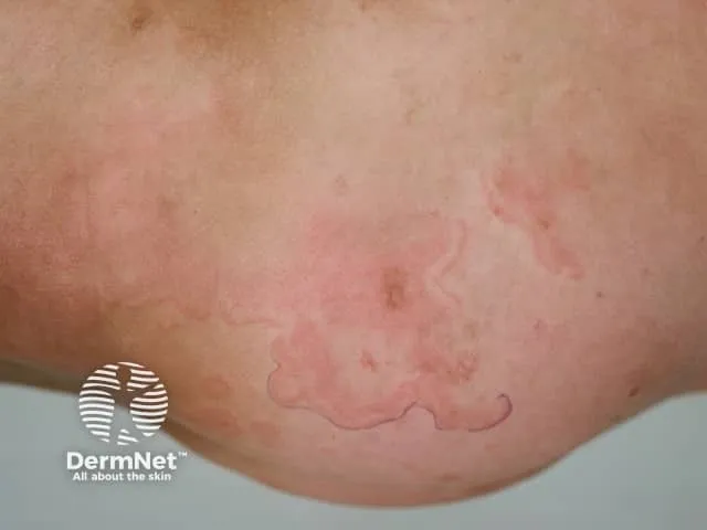 Erythema marginatum — non-pruritic, painless, flat or slightly raised rash with irregular or snake-like edges