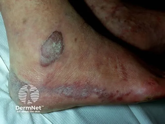Classic Kaposi sarcoma — localised, nodular and painless violaceous lesions