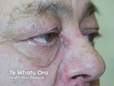 Nodular basal cell carcinoma on the upper nasolabial fold
