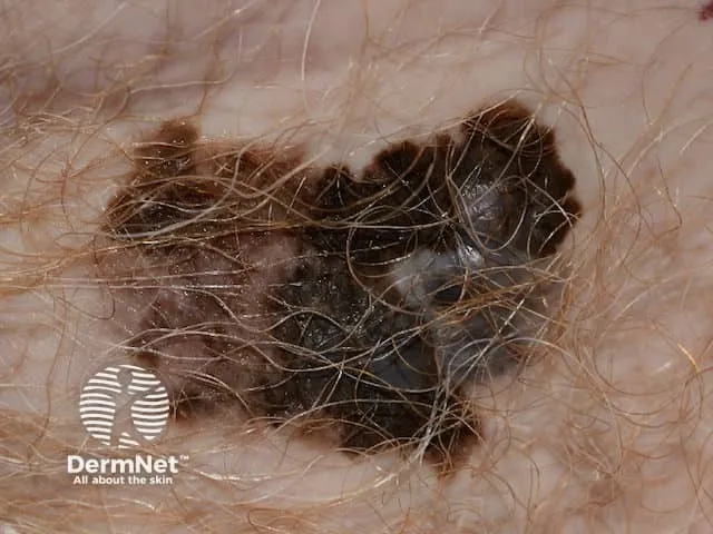 Superficial malignant melanoma with irregular and notched margin, variable pigmentation