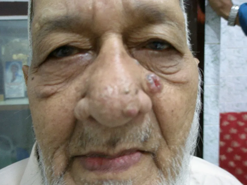 Basal cell carcinoma on facial skin
