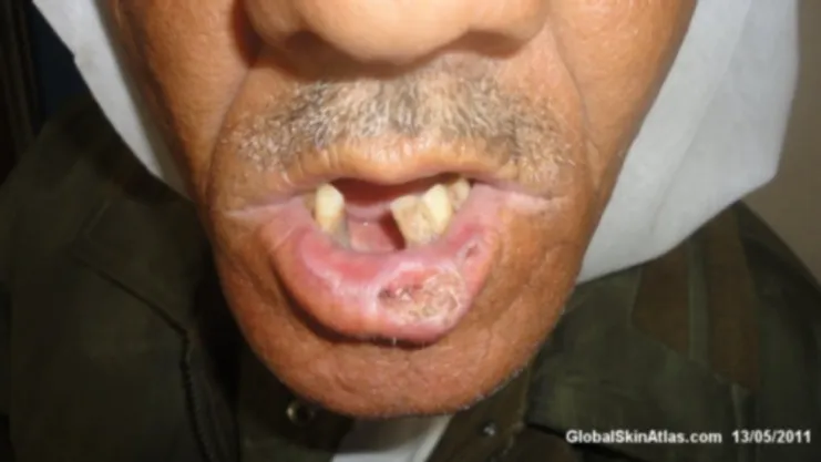 Squamous cell carcinoma and lichen planus lesions