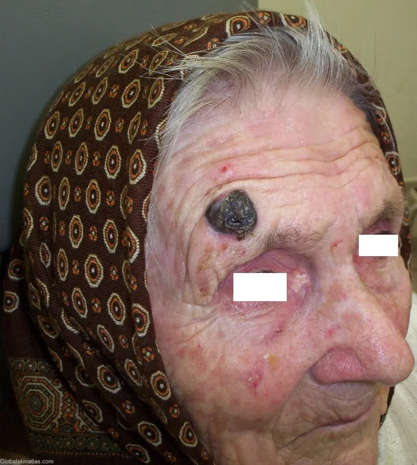 Melanoma lesion showing irregular pigmentation