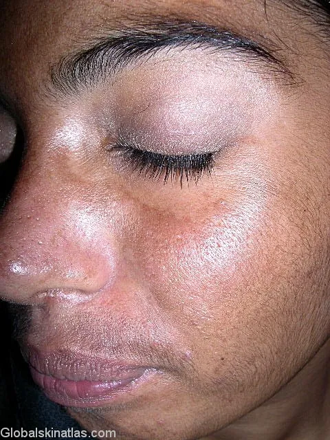 Melasma — symmetrical hyperpigmentation across both cheeks