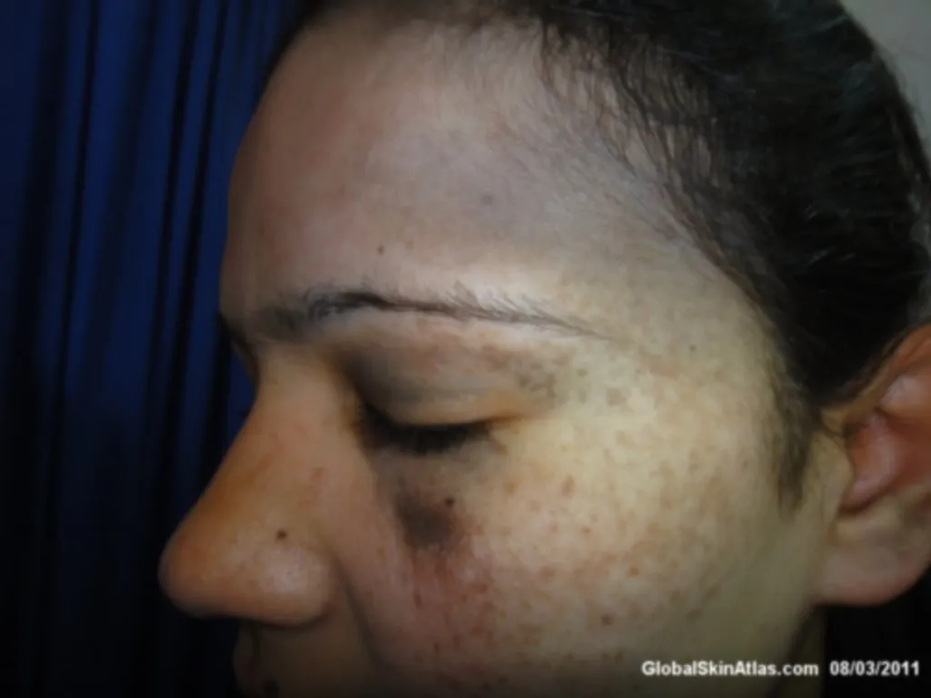 Nevus of Ota — bilateral bluish-brown macules on the face