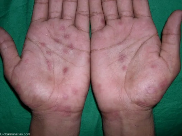 Maculopapular rash on the trunk characteristic of secondary syphilis