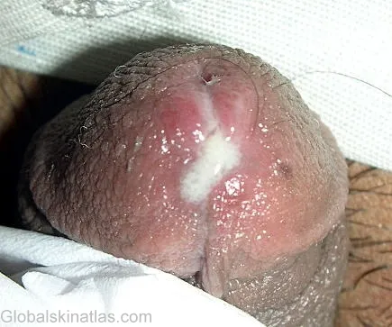 Urethral discharge in gonorrhoea