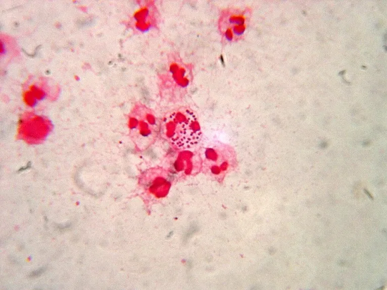Gram-negative diplococci on microscopy in gonorrhoea