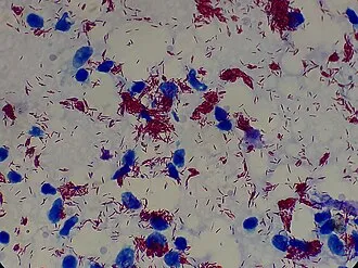 Acid-fast staining of M. leprae showing red bacilli under Ziehl–Neelsen stain