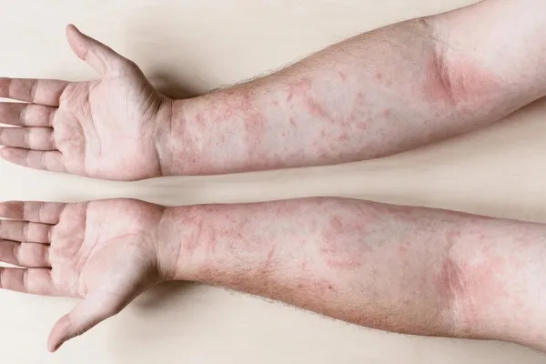 Allergic contact dermatitis