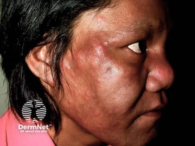 Lepromatous leprosy — facial infiltration with nodular changes