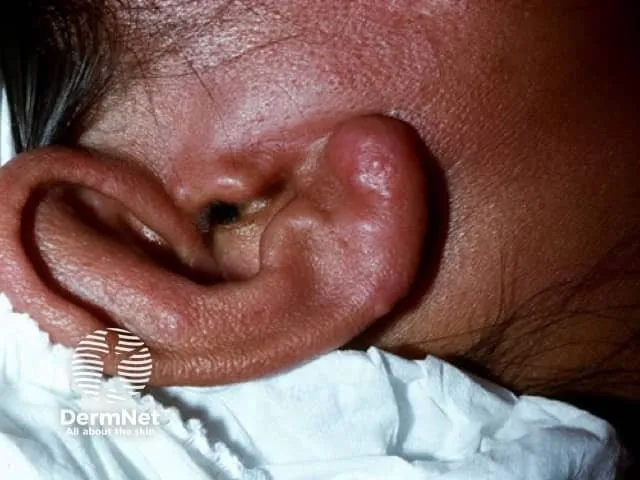 Lepromatous leprosy — thickening of the earlobe