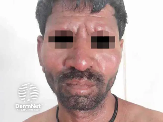Leonine facies with loss of eyebrows and infiltrated facial skin in lepromatous leprosy