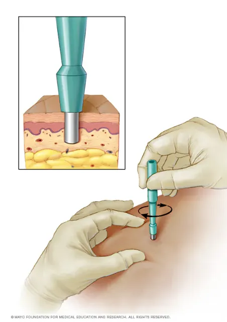 Close-up of a punch biopsy being performed on skin