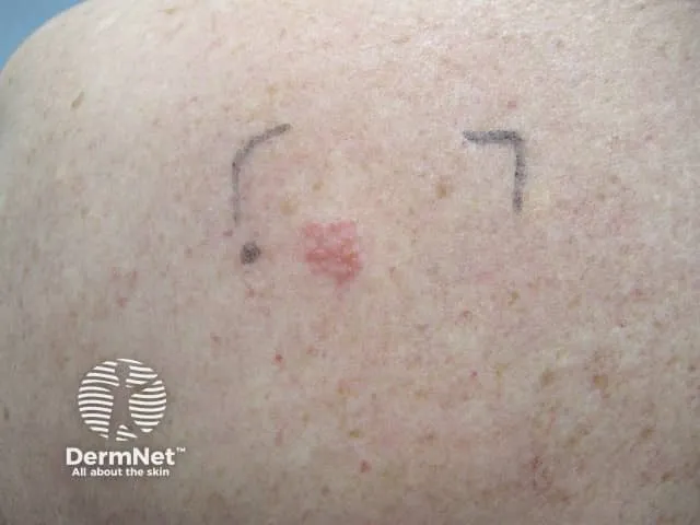 Patch test on the back showing positive reactions at day 5 for nickel contact allergy