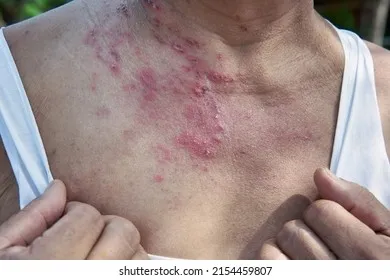 Irritant contact dermatitis