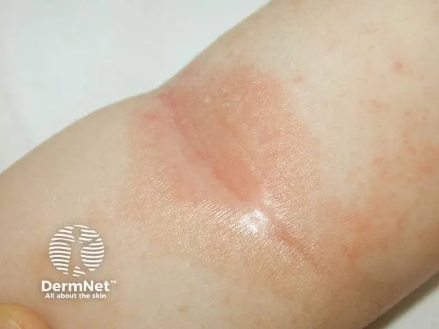 Infantile seborrhoeic dermatitis in the antecubital fossa